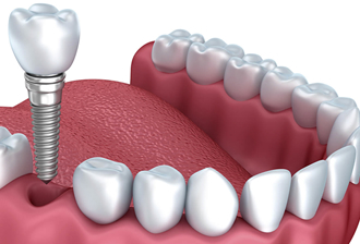 Implantodontia - Especialidades - Salut Clínica Odontológica e Médica